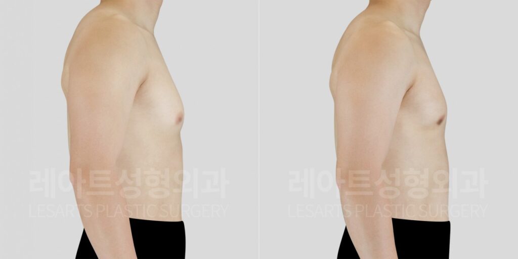 남자 여유증 수술 2개월 전후, 옆모습으로 확인한 가슴 두께와 밑가슴 각도