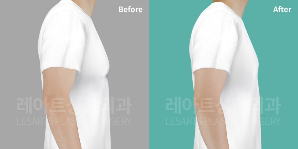 유륜절개 여유증 수술 2개월 후, 티셔츠 측면 변화