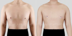 남자 여유증수술 | 한쪽 가슴만 더 커 보인다면? 2주 전후 비교 – 레아트성형외과