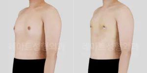 남자 여유증 수술 2주 후, 비스듬한 각도에서 확인한 가슴라인 변화