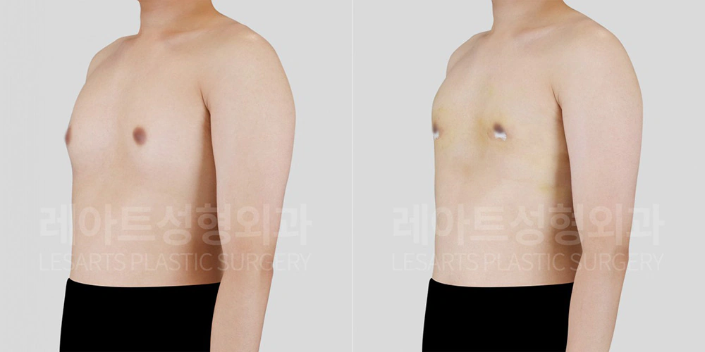 남자 여유증 수술 2주 후, 비스듬한 각도에서 확인한 가슴라인 변화