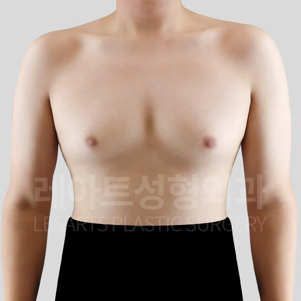여유증수술 전, 양쪽 가슴 크기와 앞가슴 돌출 확인
