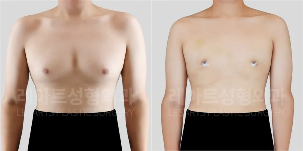 남자 여유증수술 2주 후, 앞가슴 돌출과 가슴 모양 변화