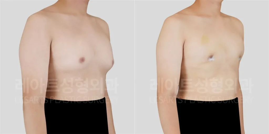 여유증 2주 후, 반측면에서 확인한 앞가슴 라인 변화