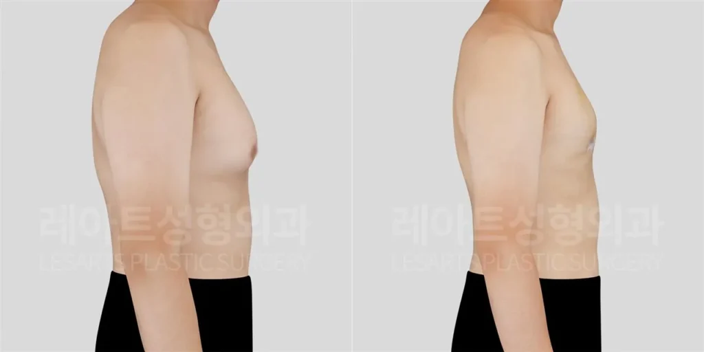 여유증 2주 후, 옆모습에서 확인한 앞가슴 돌출 변화