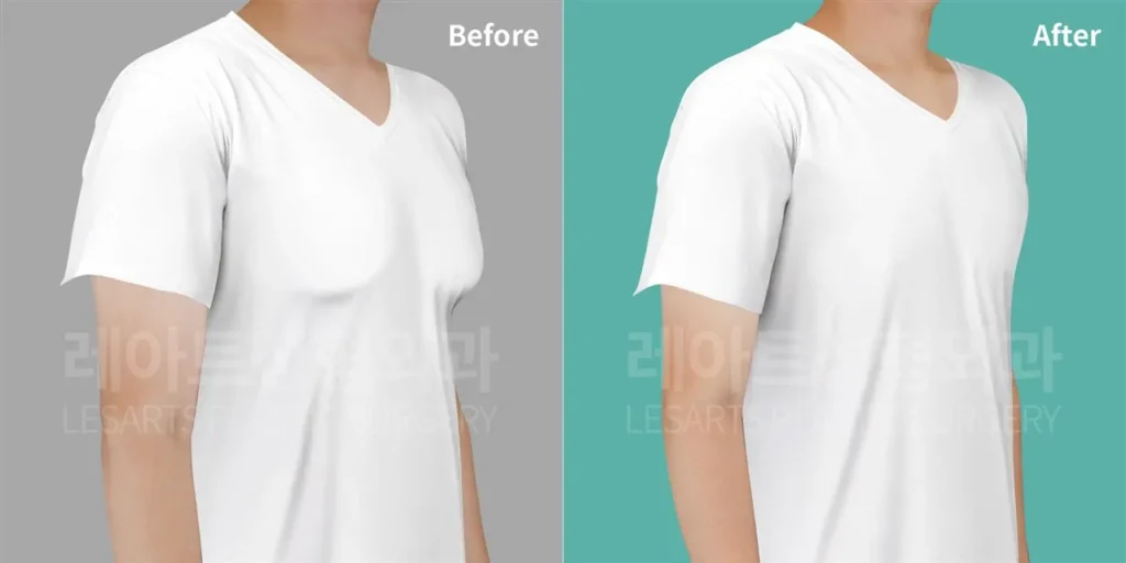 티셔츠 위로 도드라져 보이던 앞가슴, 여유증 2주 후 반측면 변화