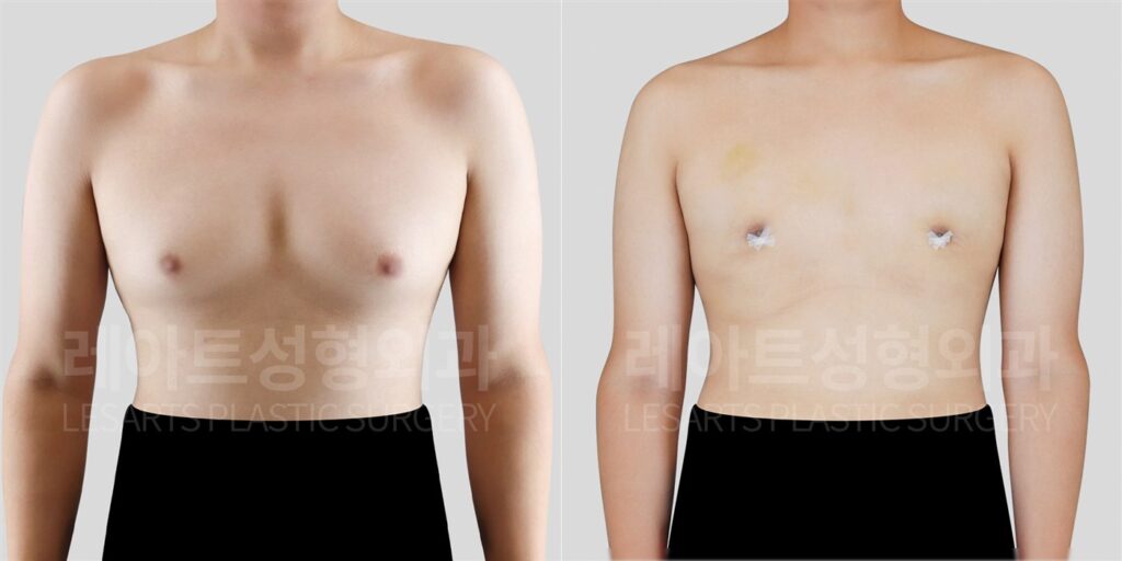 남자 여유증수술 | 2주 후 일상생활과 티셔츠핏은 어떻게 달라질까? 전후 비교