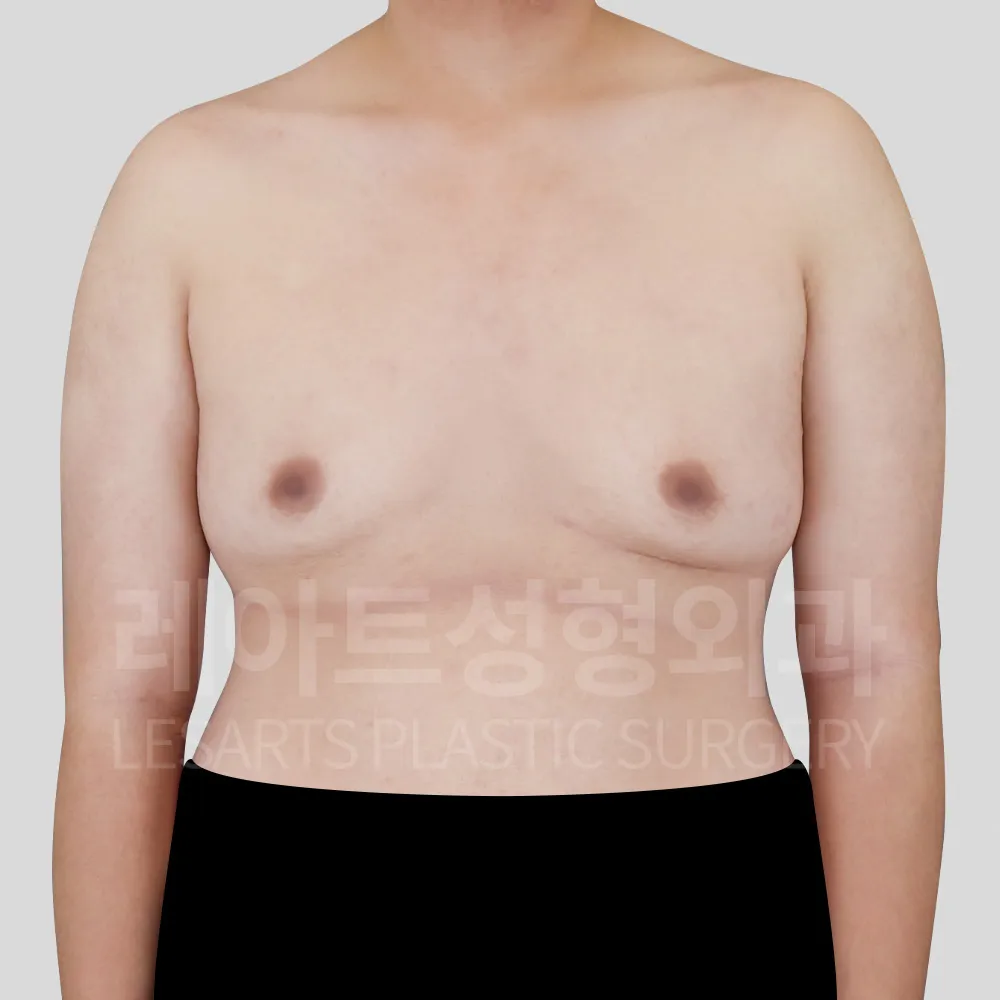 여유증수술 전, 가슴 돌출과 피부 처짐이 함께 확인된 상태