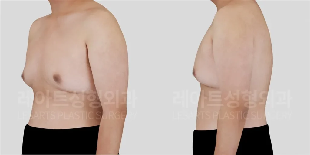 사이먼그레이드 2B 여유증, 피부 처짐을 고려한 수술 계획