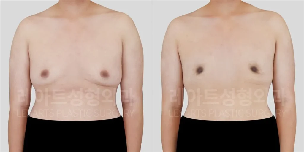 여유증수술 3개월 후, 앞모습에서 확인한 가슴 크기와 피부 처짐 변화