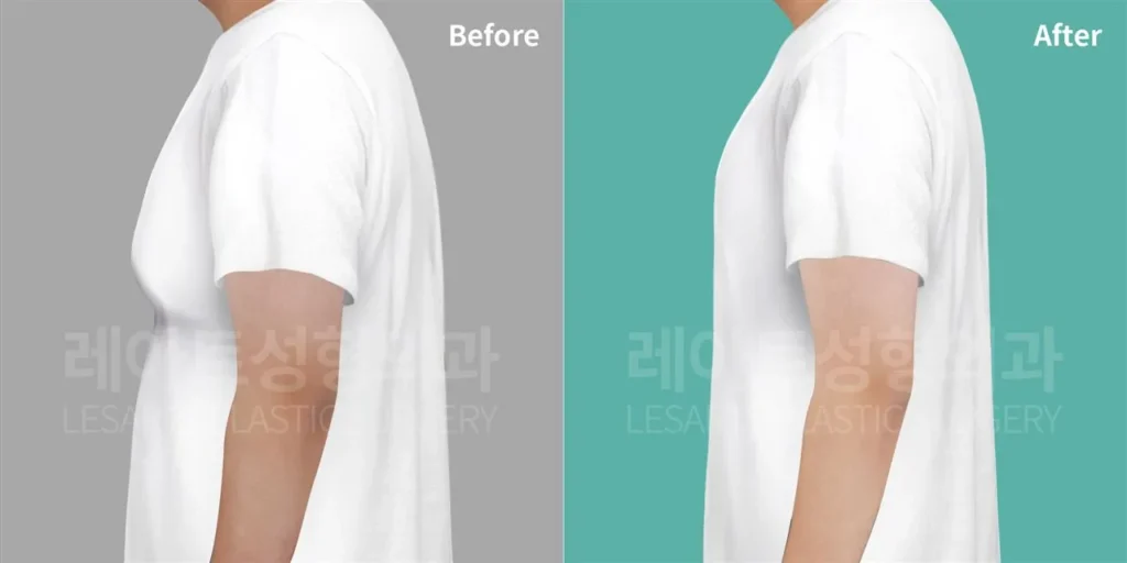 피부 처짐이 동반된 여유증, 수술 3개월 후 티셔츠 옆모습 변화