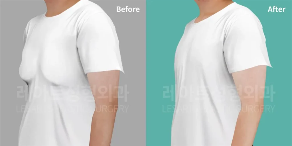 사이먼그레이드 2B 여유증, 3개월 후 티셔츠 가슴 라인 변화