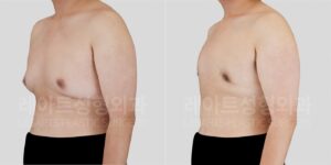 남자 여유증수술 | 가슴 처짐이 있는 사이먼그레이드 2B, 3개월 후 변화 전후 비교