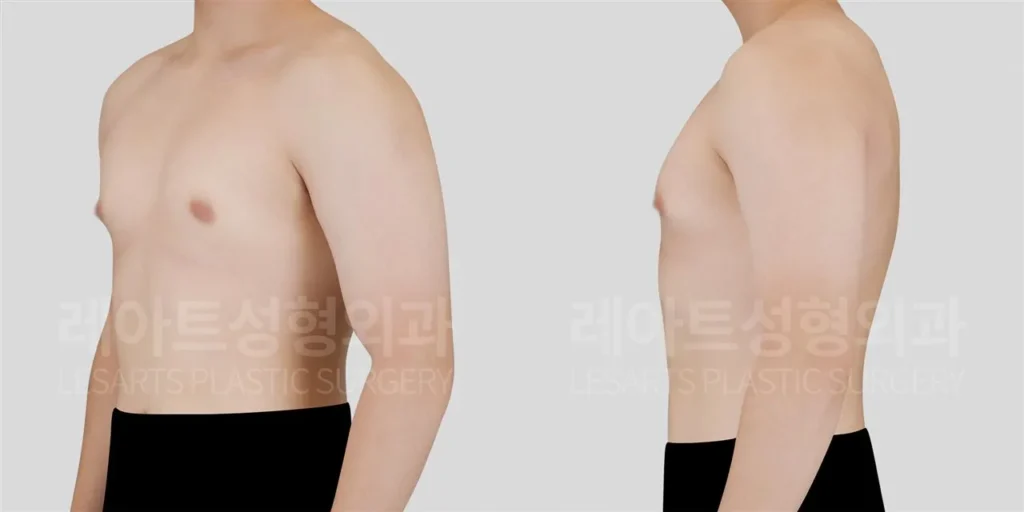 청소년기부터 이어진 가슴 돌출, 여유증수술 전 상태 확인