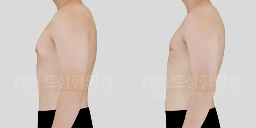 청소년기부터 이어진 여유증, 수술 2주 후 앞가슴 돌출 변화