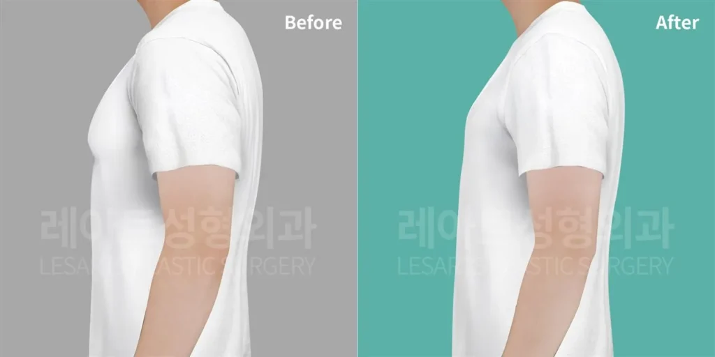 청소년기부터 이어진 여유증, 수술 2주 후 티셔츠핏 변화 정면