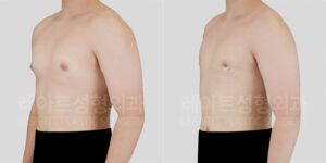 남자 여유증 | 청소년기부터 이어진 가슴 돌출, 추적관찰 후 수술 2주 변화 전후 비교