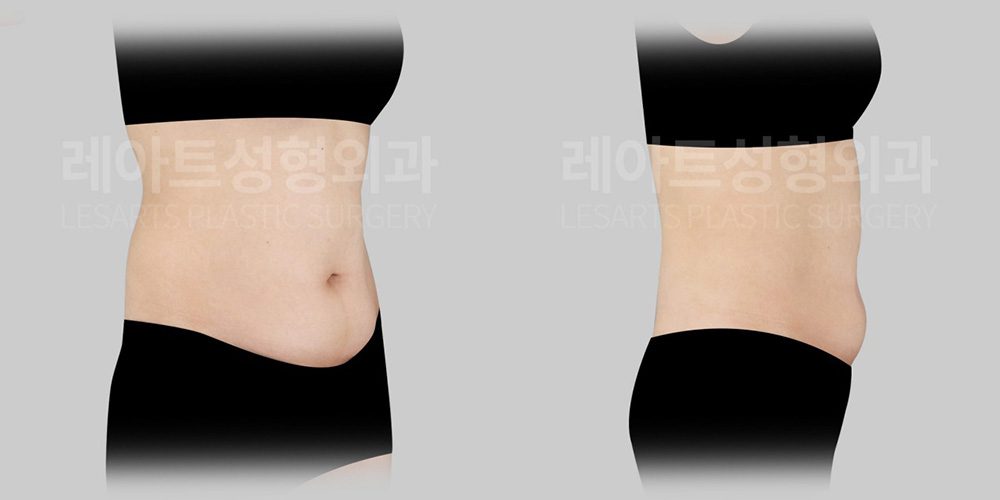 복부거상수술 전, 하복부 돌출과 늘어진 복벽을 고려한 수술 계획