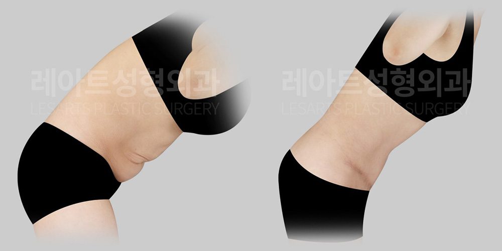 복부거상수술 1년 4개월 후, 허리를 숙었을 때 복부 피부 접힘 변화