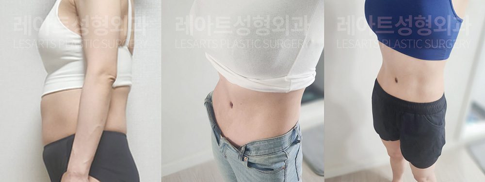 복부거상 수술 전 / 2개월 / 3개월 셀카 비교