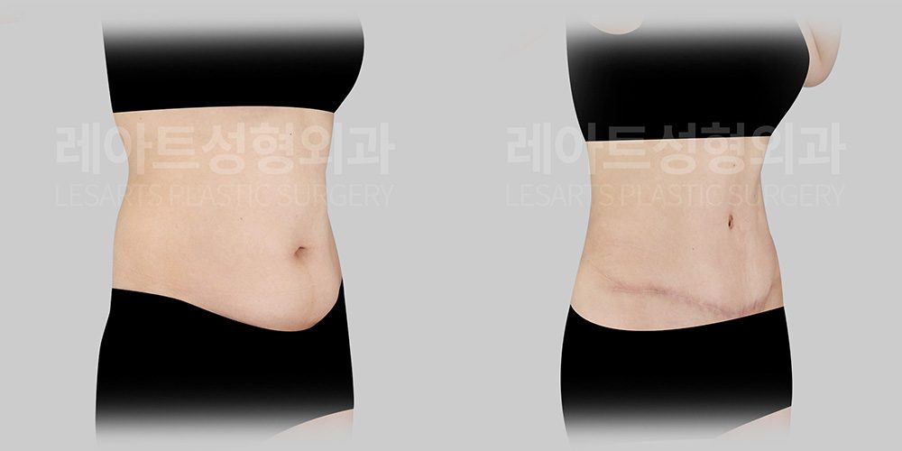복부거상수술 | 체중 감량 후 남은 아랫배 처짐과 복벽 늘어짐 개선
