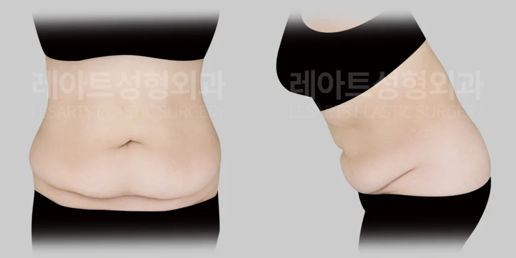 복부거상 수술전, 배꼽 아래 피부 처짐과 복부 두께감 확인