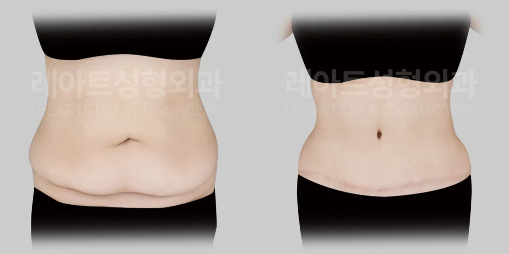 복부거상수술 1년 3개월 후 정면에서 확인한 하복부 처짐과 배꼽 형태 변화