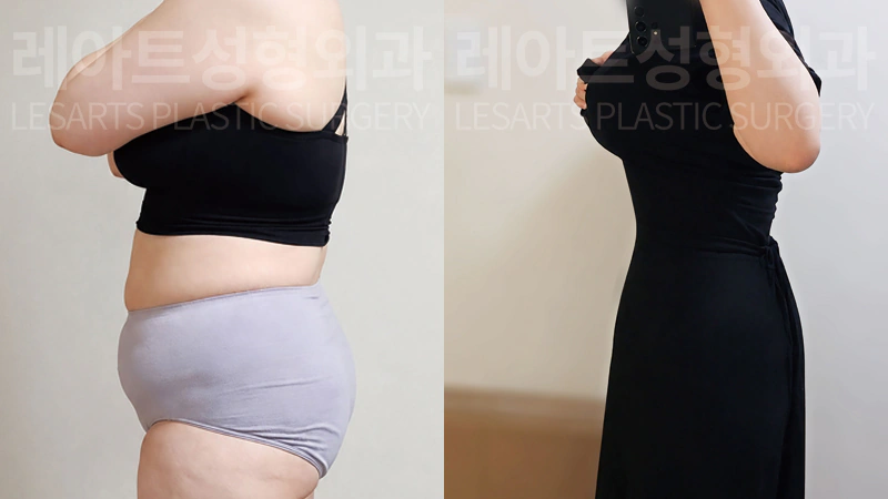 복부거상수술 전후 측면 셀카 비교