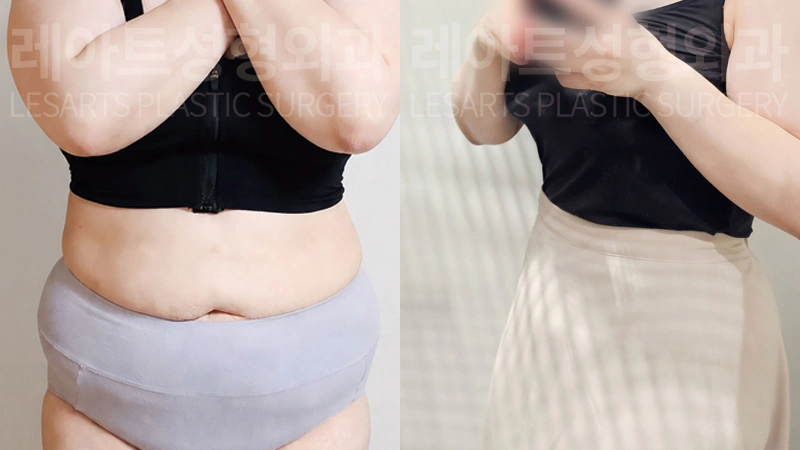 복부거상수술 전후 정면 셀카 비교