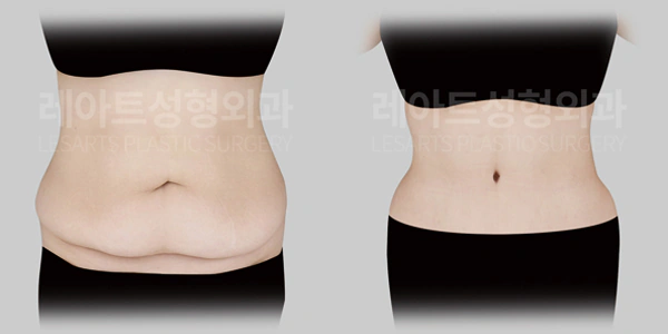 복부거상수술 | 1년 3개월 후에도 결과가 잘 유지될까?