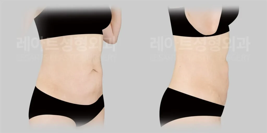 복부거상수술 전, 하복부 처짐과 복벽 상태를 고려한 수술 계획