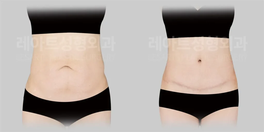 복부거상수술 1년 후, 하복부 돌출과 허리라인 변화