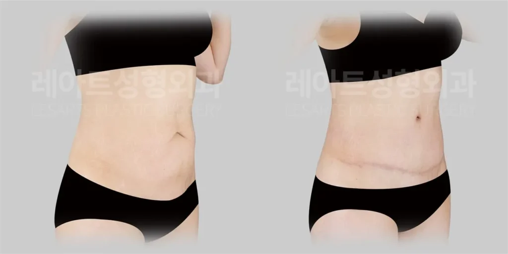 복부거상 1년 후, 늘어진 아랫배 피부와 배꼽 모양 변화