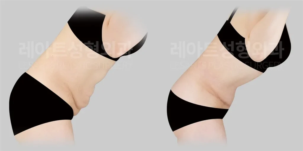 복부거상 1년 후, 허리를 숙였을 때 확인한 하복부 피부 처짐과 접힘 변화