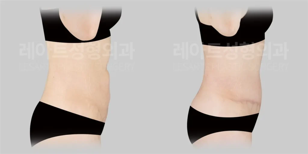 복부거상 1년 후, 옆모습에서 확인한 하복부 돌출과 앞복부 라인 변화