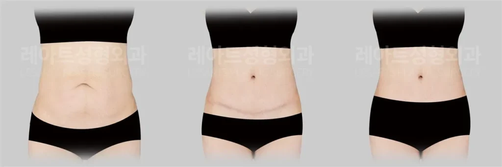 복부거상수술 1년 후, 하복부 절개 흉터 회복 상태