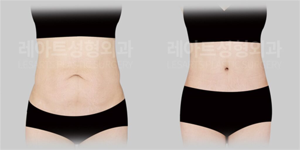 복부거상수술 | 출산 후 아랫배 처짐, 전체 복부거상이 필요했던 이유 전후 비교