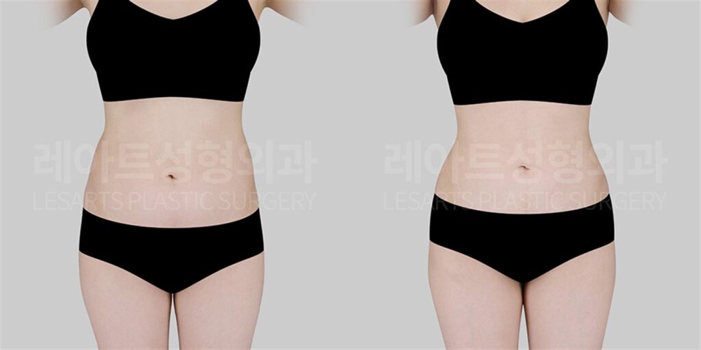 복부지방흡입 | 하복부만 볼록, 다이어트로 끝나지 않는 뱃살 고민 왜 그럴까요? (3개월 후) 전후 비교