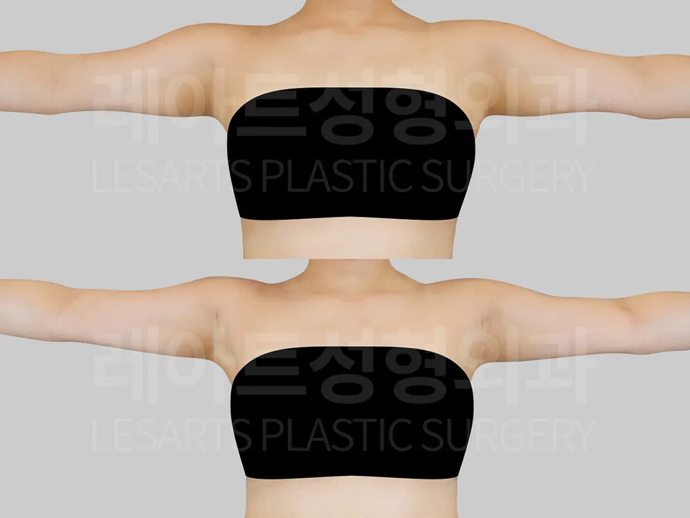팔, 겨드랑이 지방흡입 전후 라인 변화