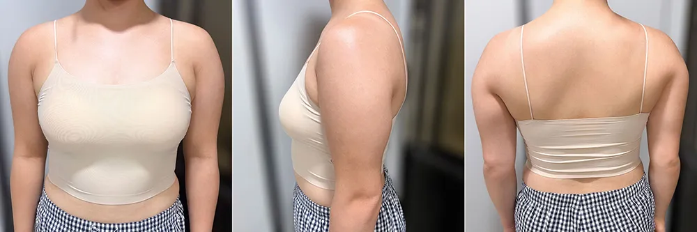 근육형 팔 지방흡입 수술 전후 셀카 비교 1