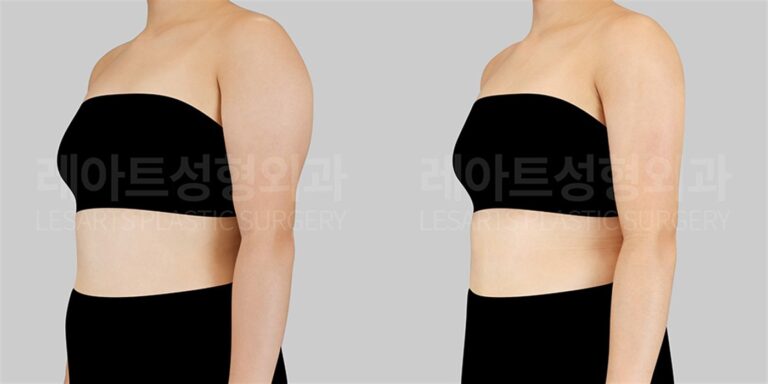 팔 지방흡입 | "근육형 팔, 지방흡입으로 정말 얇아질까? 팔 운동만으로 안 빠지는 살때문에 고민하는 분들께" (1.5개월 후) 전후 비교