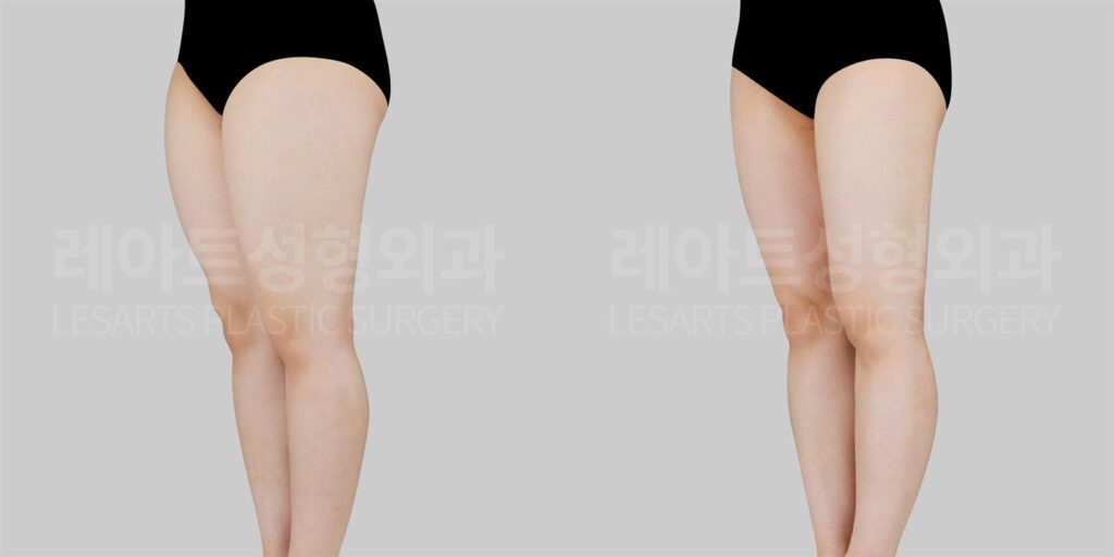 허벅지지방흡입 | 지방흡입 후 체중관리가 중요한 이유와 일자다리 변화 [닥터's 노트 by.서용승 원장] 전후 비교
