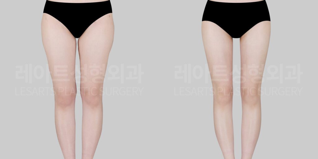 지방흡입은 체형관리의 끝이 아닌 시작 (허벅지 지방흡입 재수술 사례 분석)
